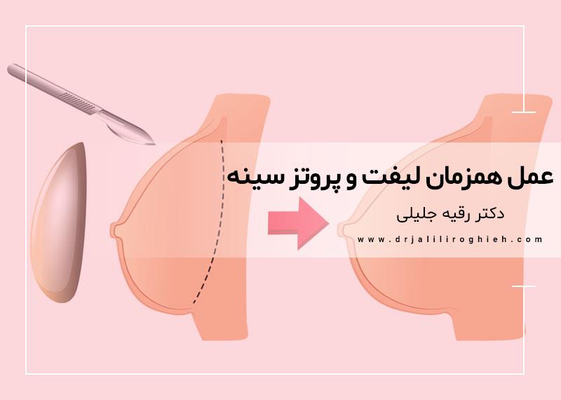 عمل همزمان لیفت و پروتز سینه | پروتزپکسی
